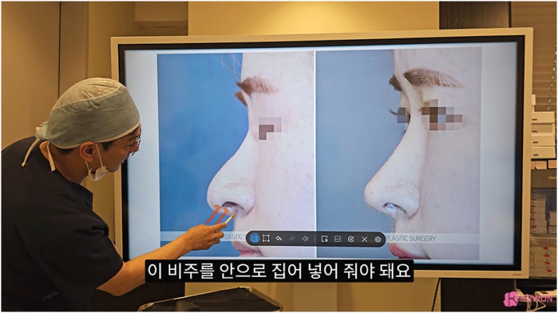 비주 처짐 콧날개 모양 수술 강남코성형외과 사진 7