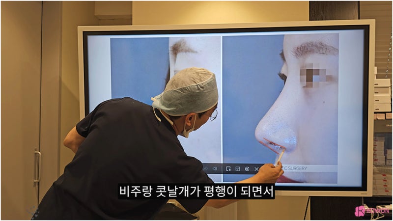 비주 처짐 콧날개 모양 수술 강남코성형외과 사진 8