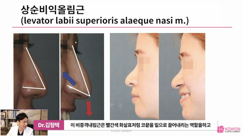 긴코 근육 콧날개내리기 화살코교정 고려 사항 사진 4