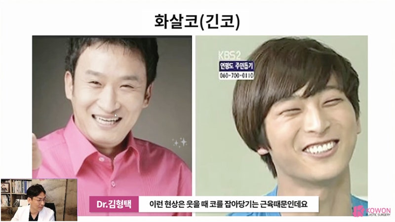 긴코 근육 콧날개내리기 화살코교정 고려 사항 사진 3