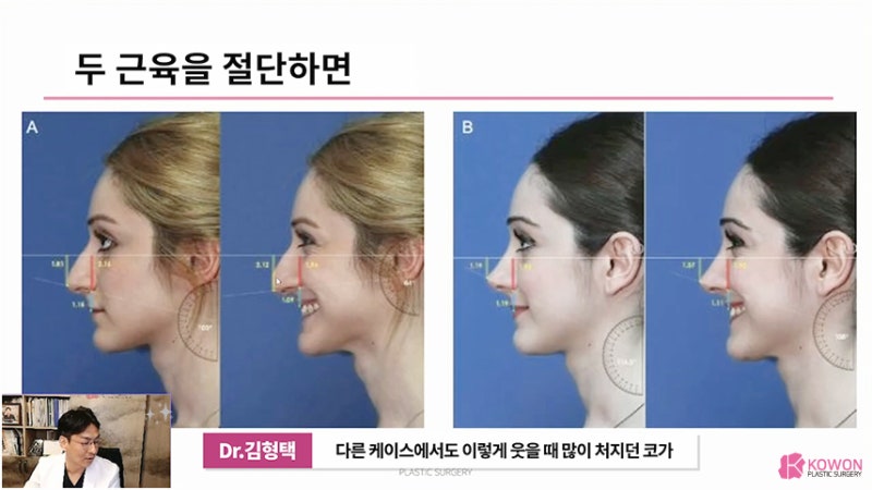 긴코 근육 콧날개내리기 화살코교정 고려 사항 사진 7