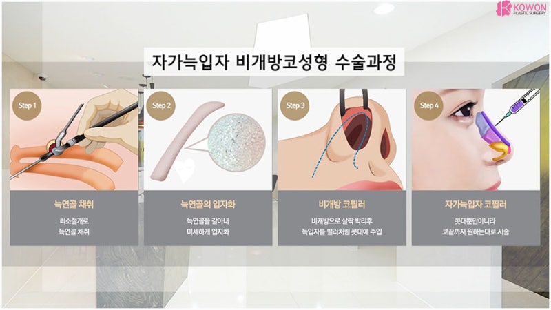비개방코성형 재료 연골 자가늑코수술 사진 4