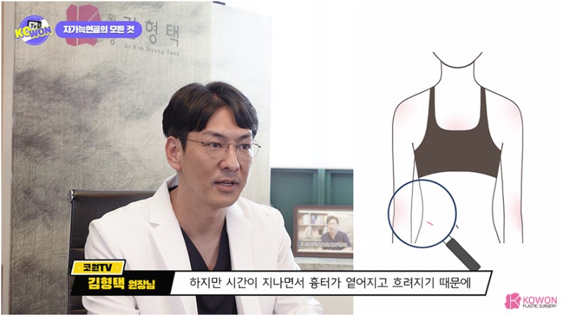 코성형연골 가슴연골 장점 단점 특징 사진 9