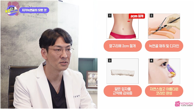 코성형연골 가슴연골 장점 단점 특징 사진 13