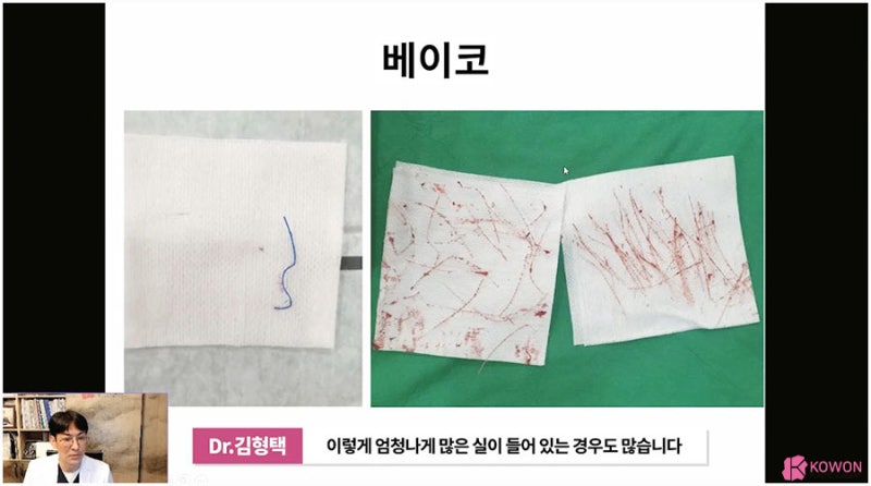 코실제거 서초동성형외과 하이코제거 코울퉁불퉁 사진 7