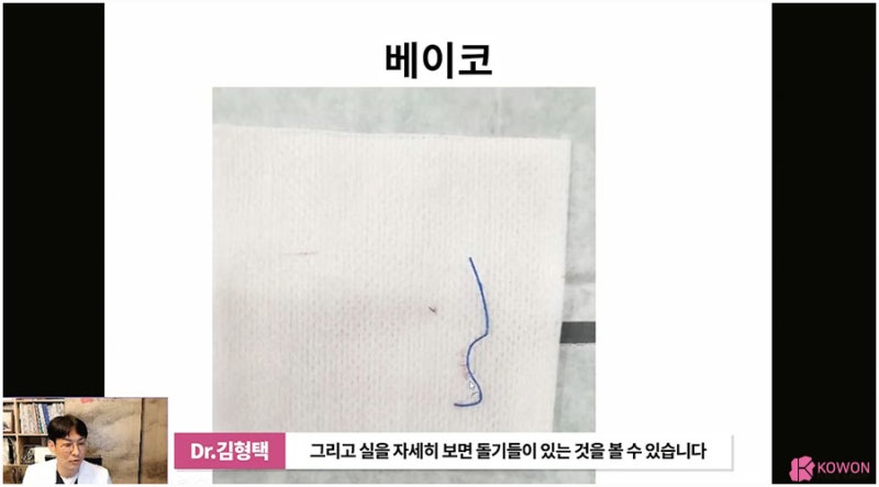 코실제거 서초동성형외과 하이코제거 코울퉁불퉁 사진 9