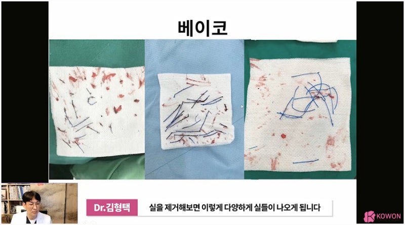 코실제거 서초동성형외과 하이코제거 코울퉁불퉁 사진 6