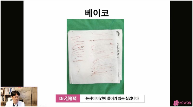 코실제거 서초동성형외과 하이코제거 코울퉁불퉁 사진 8