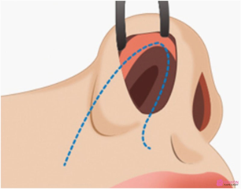 코수술필러 비개방코성형 자가늑입자 필러, 자가늑입자 보형물 비개방수술 리브핏 사진 4