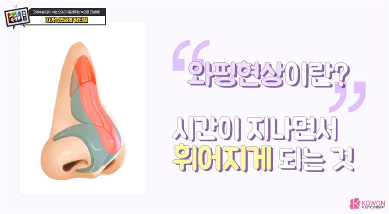 자가늑연골 부작용 코성형연골 코수술후휨 사진 10