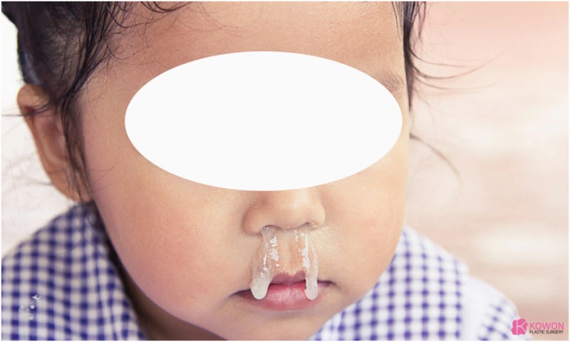 코에 염증 코염증냄새 연고 약 치료 박테리아 감염 사진 3