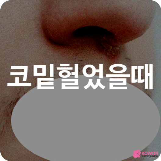 코밑헐었을때 헐음 진물 연고 원인 생활습관 면역력