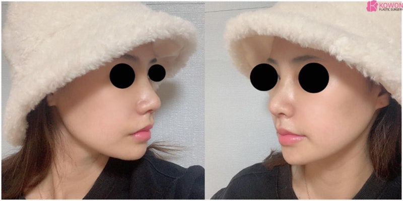 직반버선코 서울강남성형외과 전후 3개월 사진 8