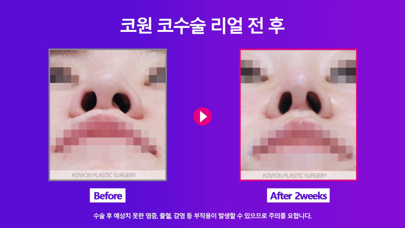 양악 수술 후 늑입자와 늑연골로 비대칭 코 교정! 사진 6