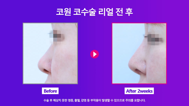 양악 수술 후 늑입자와 늑연골로 비대칭 코 교정! 사진 8