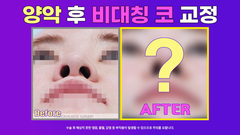 양악 수술 후 늑입자와 늑연골로 비대칭 코 교정!
