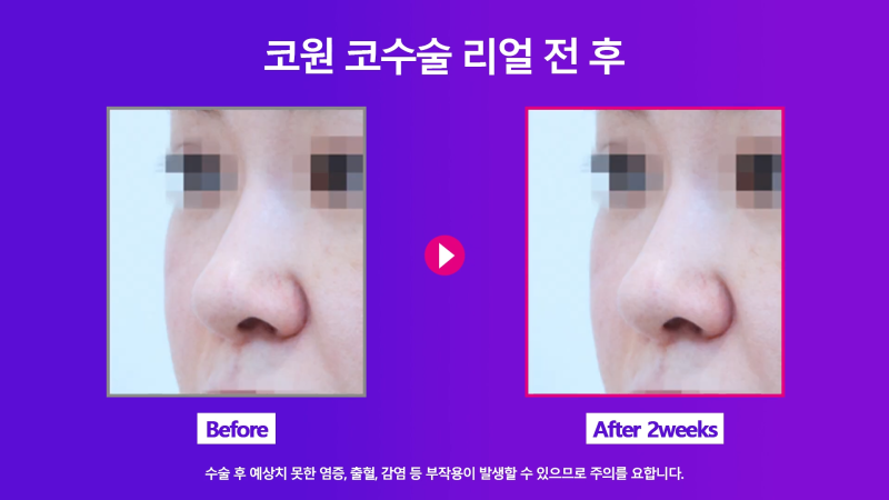양악 수술 후 늑입자와 늑연골로 비대칭 코 교정! 사진 7