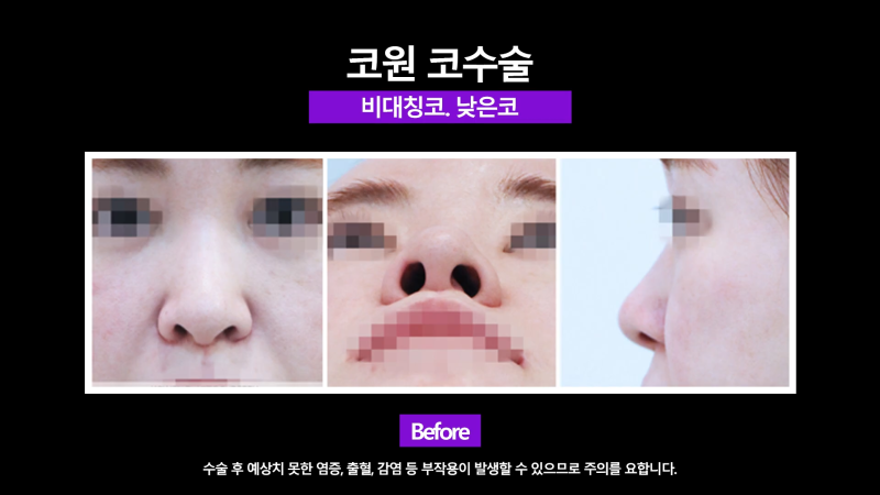 양악 수술 후 늑입자와 늑연골로 비대칭 코 교정! 사진 4