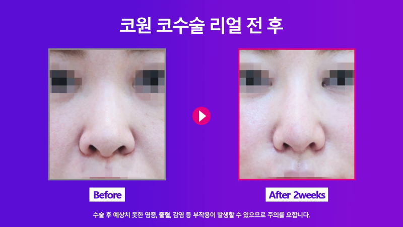 양악 수술 후 늑입자와 늑연골로 비대칭 코 교정! 사진 5