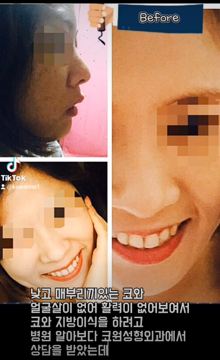 매부리코 교정 + 지방이식으로 세련된 코로 다시 태어났어요!! 사진 6