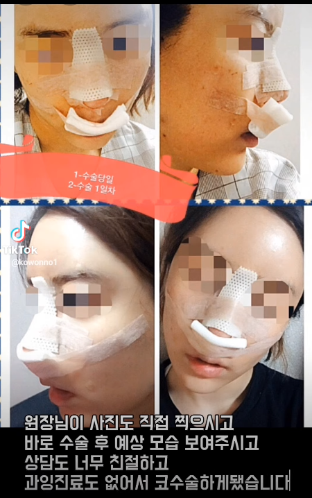 매부리코 교정 + 지방이식으로 세련된 코로 다시 태어났어요!! 사진 7