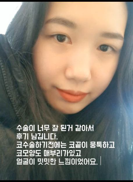매부리코 교정 + 지방이식으로 세련된 코로 다시 태어났어요!!