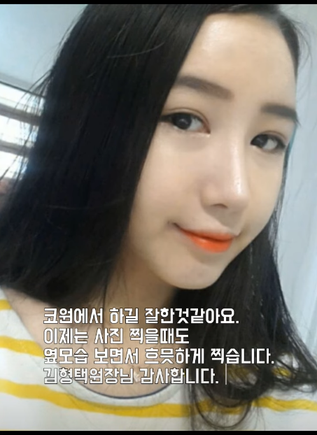 매부리코 교정 + 지방이식으로 세련된 코로 다시 태어났어요!! 사진 4
