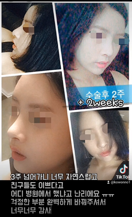 매부리코 교정 + 지방이식으로 세련된 코로 다시 태어났어요!! 사진 9