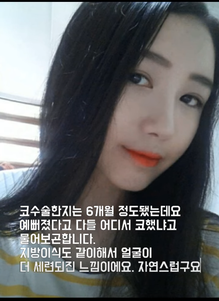 매부리코 교정 + 지방이식으로 세련된 코로 다시 태어났어요!! 사진 3