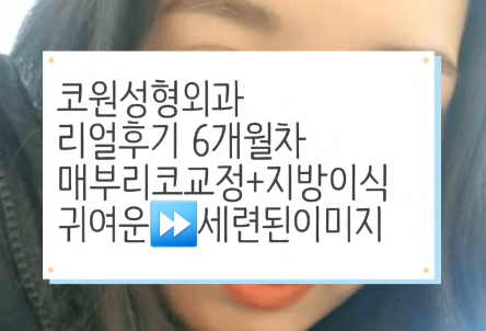 매부리코 교정 + 지방이식으로 세련된 코로 다시 태어났어요!!