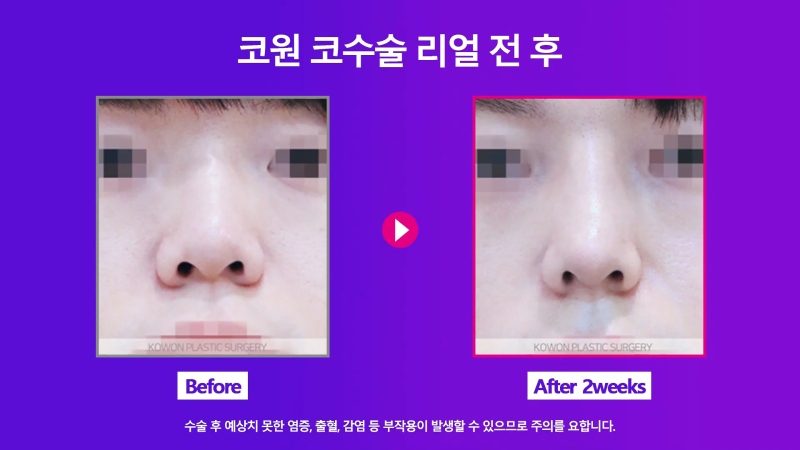 남자코끝 개선해 직선코로 다시 태어난 사례! 사진 5