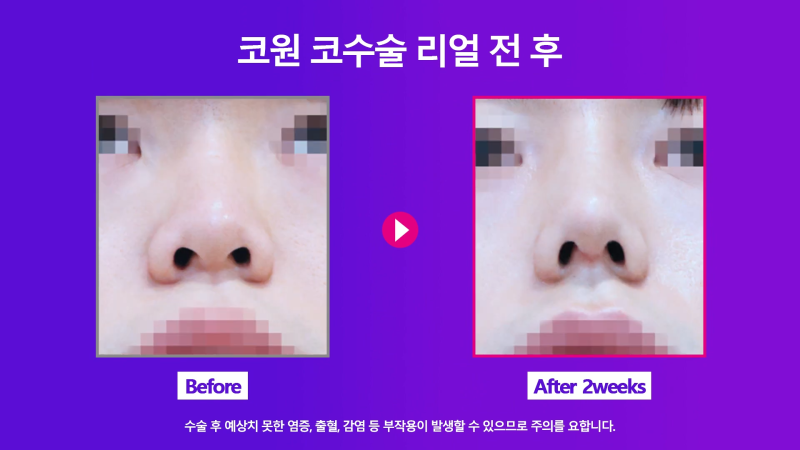 남자코끝 개선해 직선코로 다시 태어난 사례! 사진 6