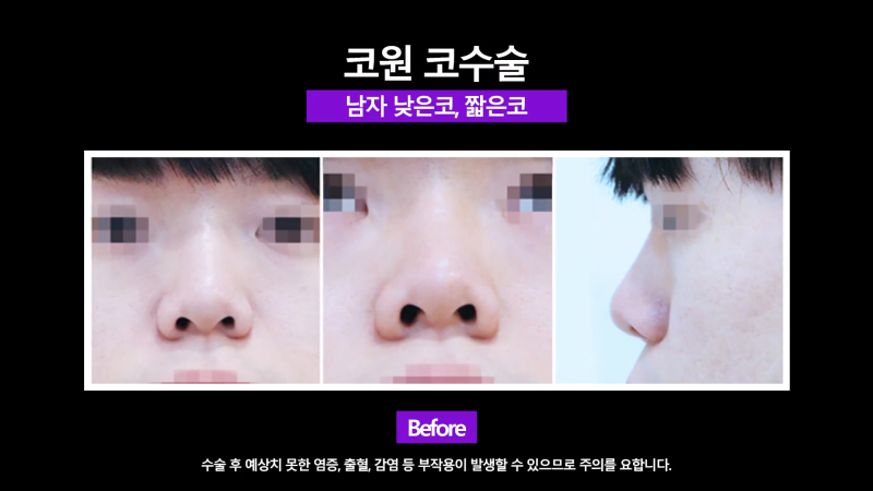남자코끝 개선해 직선코로 다시 태어난 사례! 사진 3
