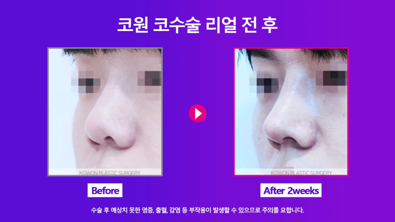 남자코끝 개선해 직선코로 다시 태어난 사례! 사진 7