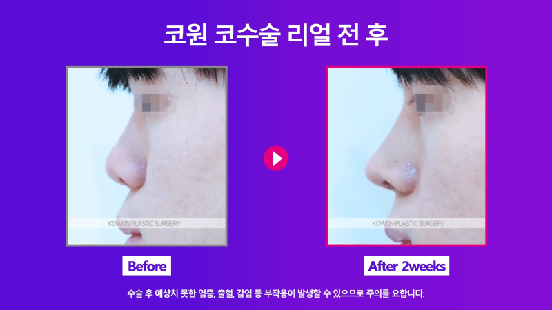 남자코끝 개선해 직선코로 다시 태어난 사례! 사진 8