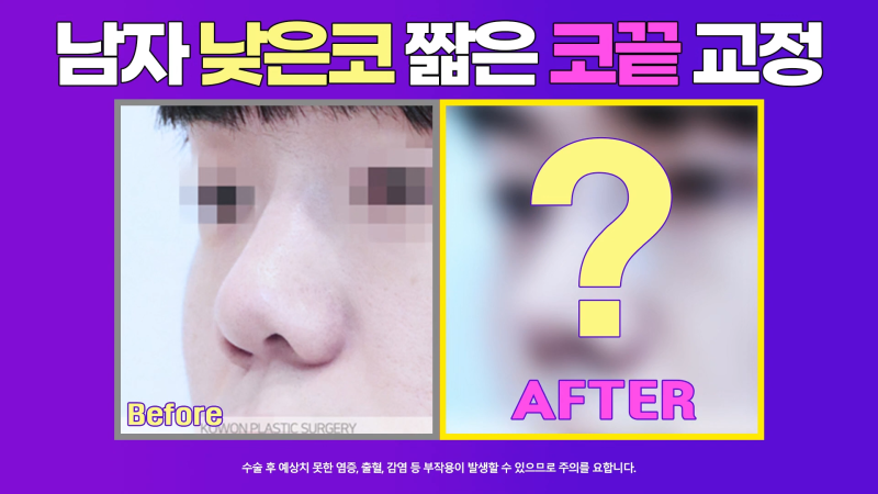 남자코끝 개선해 직선코로 다시 태어난 사례!