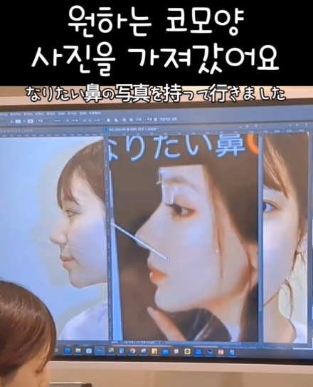 코수술 당일 진행 과정과 2주 차 경과 모습 원장님과 같이 확인했어요! 사진 3