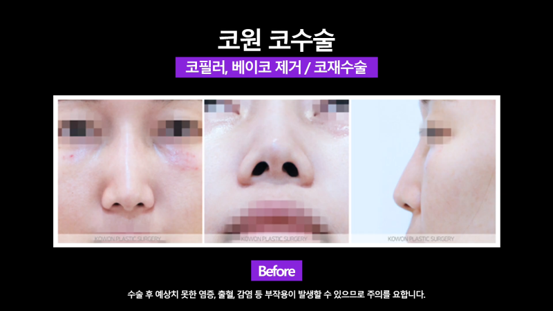 쁘띠시술 베이코 제거 후 코 성형한 후기!