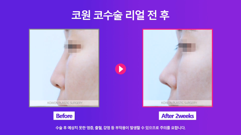 쁘띠시술 베이코 제거 후 코 성형한 후기! 사진 8