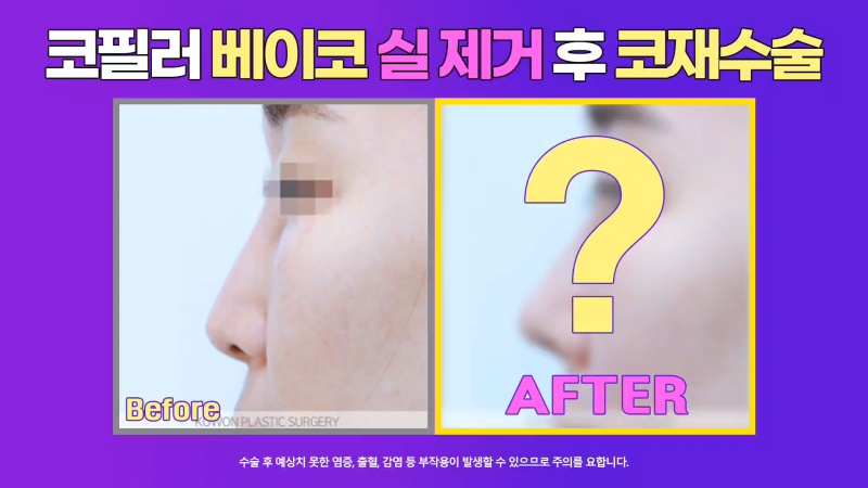 쁘띠시술 베이코 제거 후 코 성형한 후기!