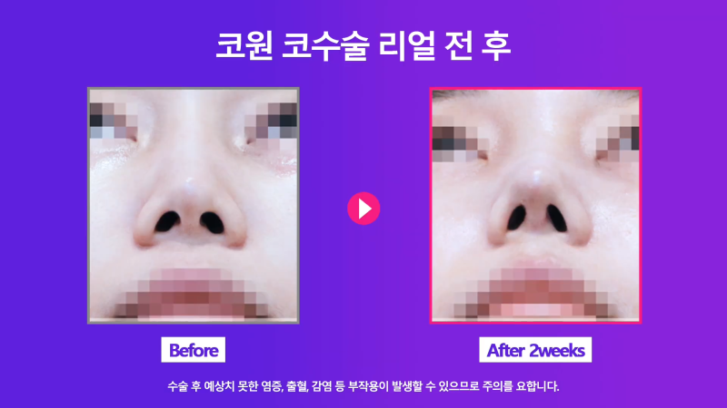 쁘띠시술 베이코 제거 후 코 성형한 후기! 사진 4