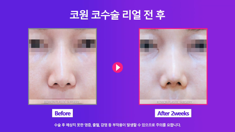 쁘띠시술 베이코 제거 후 코 성형한 후기! 사진 3