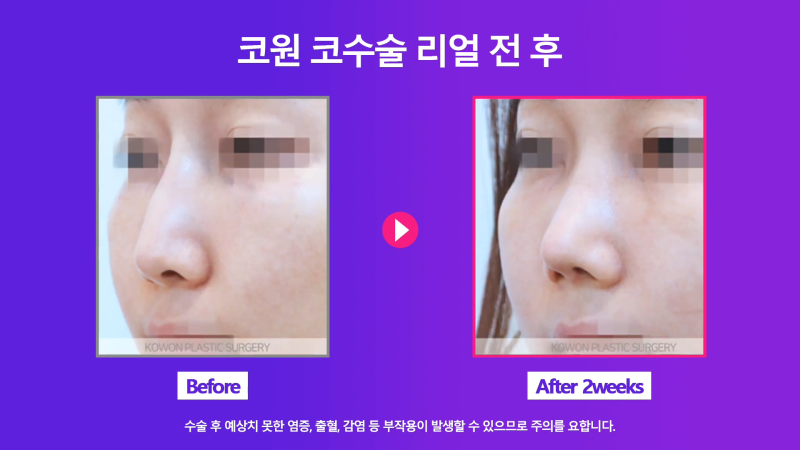 쁘띠시술 베이코 제거 후 코 성형한 후기! 사진 7