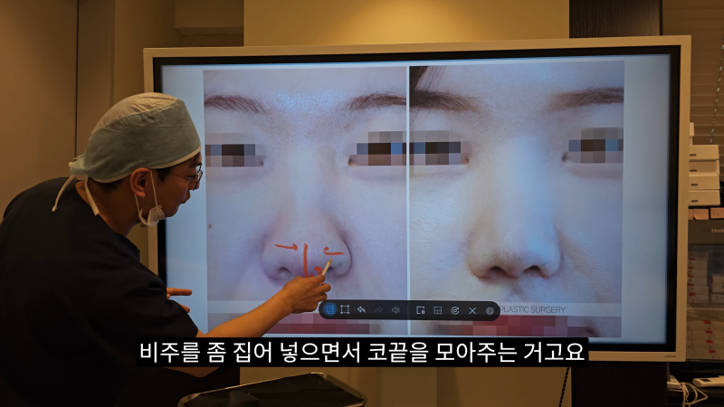 예쁜 코를 위한 비주와 콧날개에 대해 알려드립니다! 2편 (넓은코, 처진콧날개) 사진 11