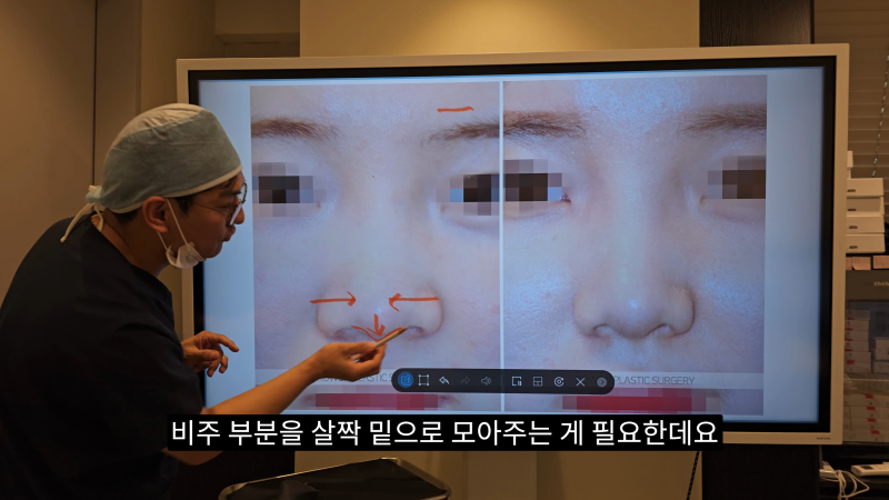 예쁜 코를 위한 비주와 콧날개에 대해 알려드립니다! 2편 (넓은코, 처진콧날개) 사진 5