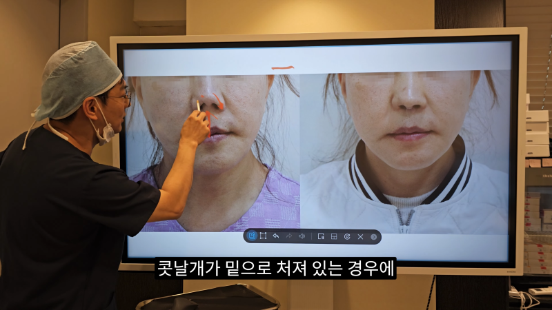 예쁜 코를 위한 비주와 콧날개에 대해 알려드립니다! 2편 (넓은코, 처진콧날개)