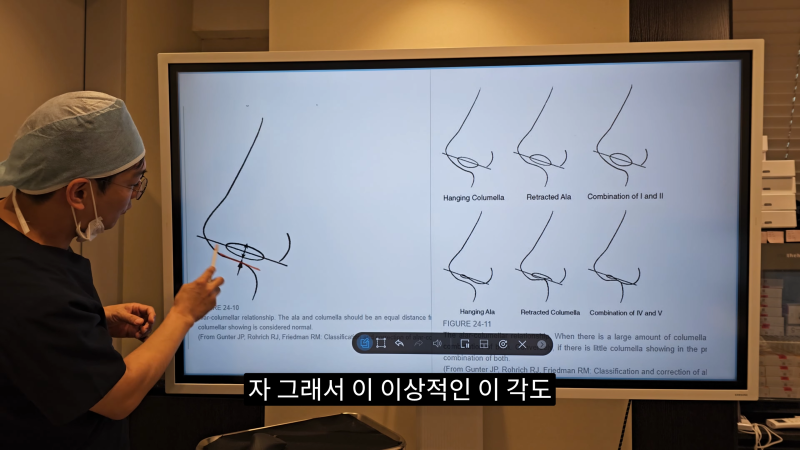 예쁜 코를 위한 비주와 콧날개에 대해 알려드립니다! 2편 (넓은코, 처진콧날개) 사진 12