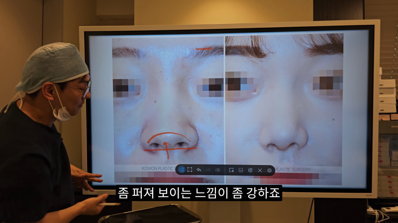 예쁜 코를 위한 비주와 콧날개에 대해 알려드립니다! 2편 (넓은코, 처진콧날개) 사진 6