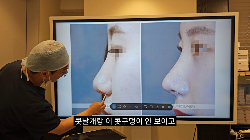 예쁜 코를 위한 비주와 콧날개에 대해 알려드립니다! 2편 (넓은코, 처진콧날개) 사진 16