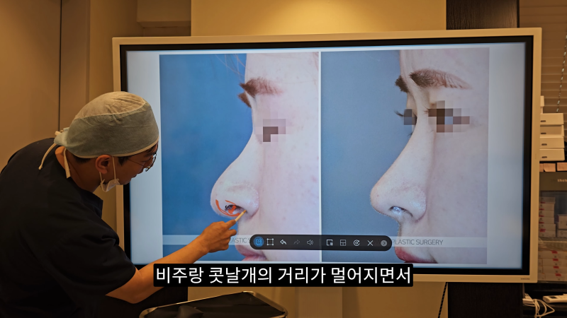 예쁜 코를 위한 비주와 콧날개에 대해 알려드립니다! 2편 (넓은코, 처진콧날개) 사진 9